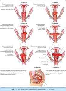 Стадии (степени) рака шейки матки и их описание