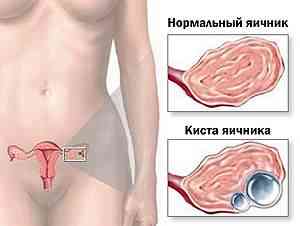 Дермоидная киста яичника: симптомы и лечение - Webmedinfo.ru