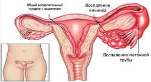 Воспаление яичников у женщин: симптомы и лечение, препараты